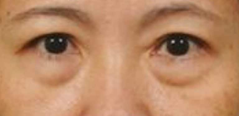 ถุงใต้ตา