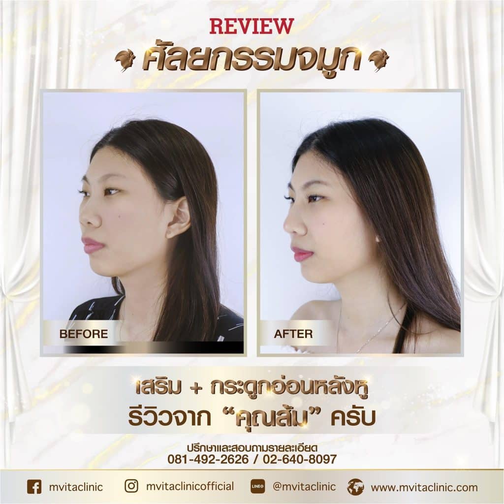 รีวิวเสริมจมูก