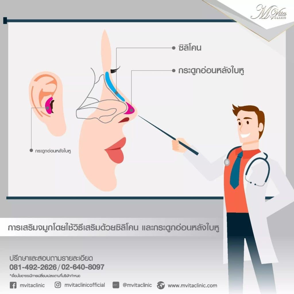 การเสริมจมูกด้วยซิลิโคนร่วมกับกระดูกอ่อนหลังใบหู คือ