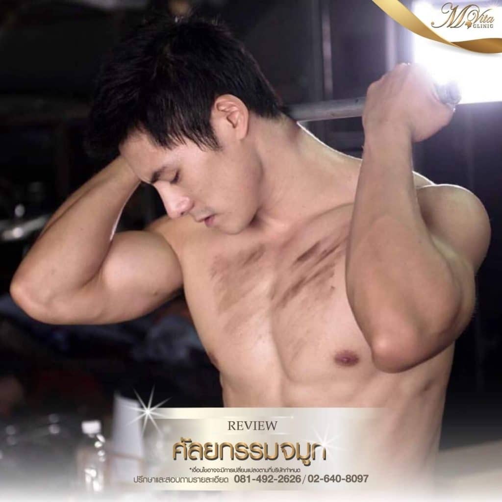 รีวิวจมูกของเอ็มวีต้าคลินิก-01