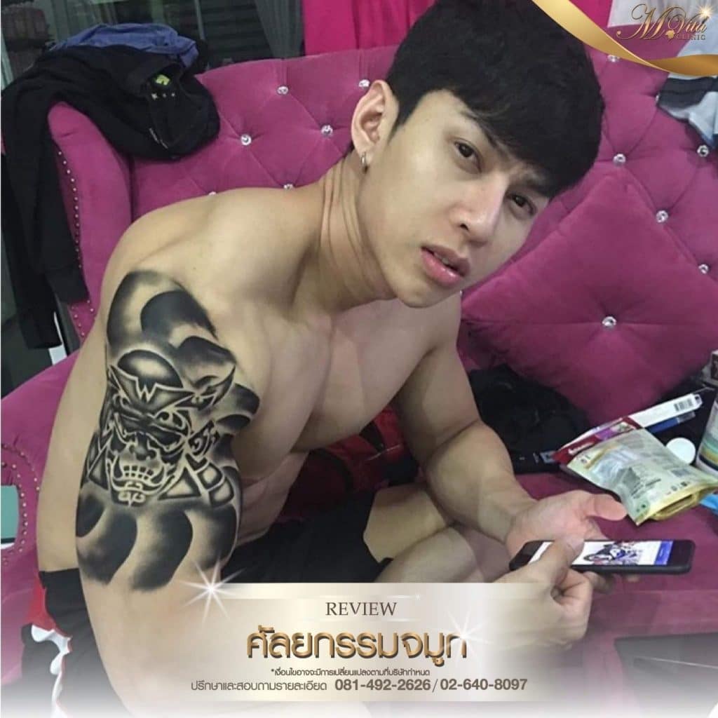 รีวิวเสริมจมูกของเอ็มวีต้าคลินิก-03