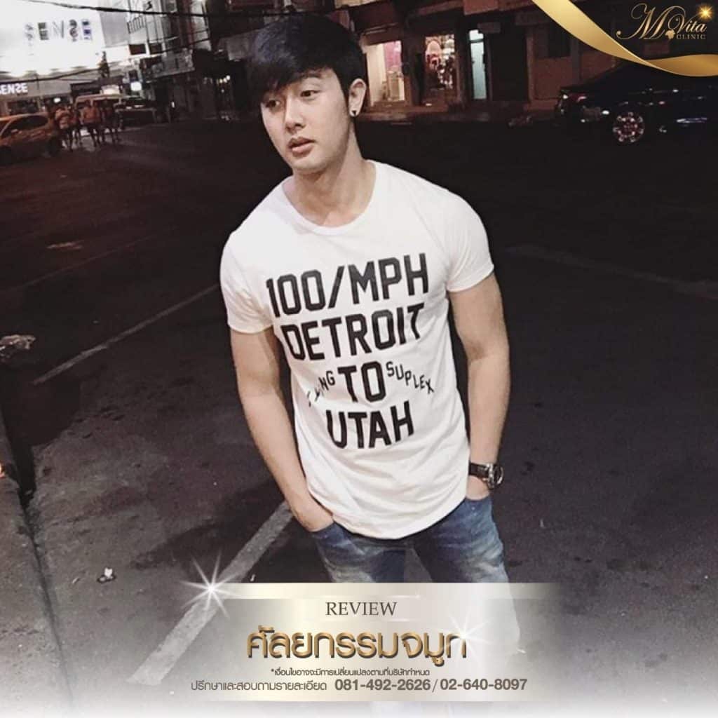 รีวิวเสริมจมูกของเอ็มวีต้าคลินิก-04