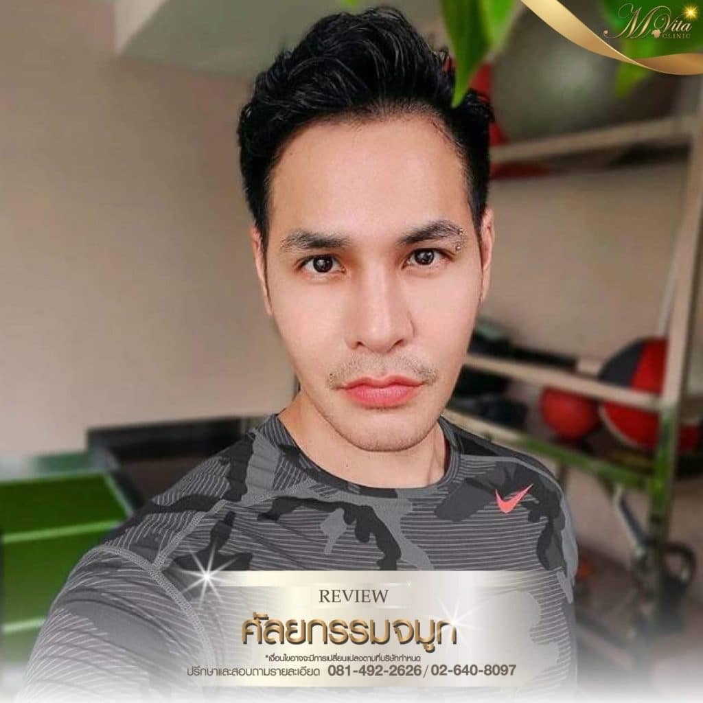 รีวิวเสริมจมูกของเอ็มวีต้าคลินิก-05