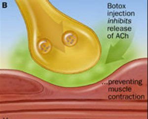 Botox injection injection inhibits release of ACh