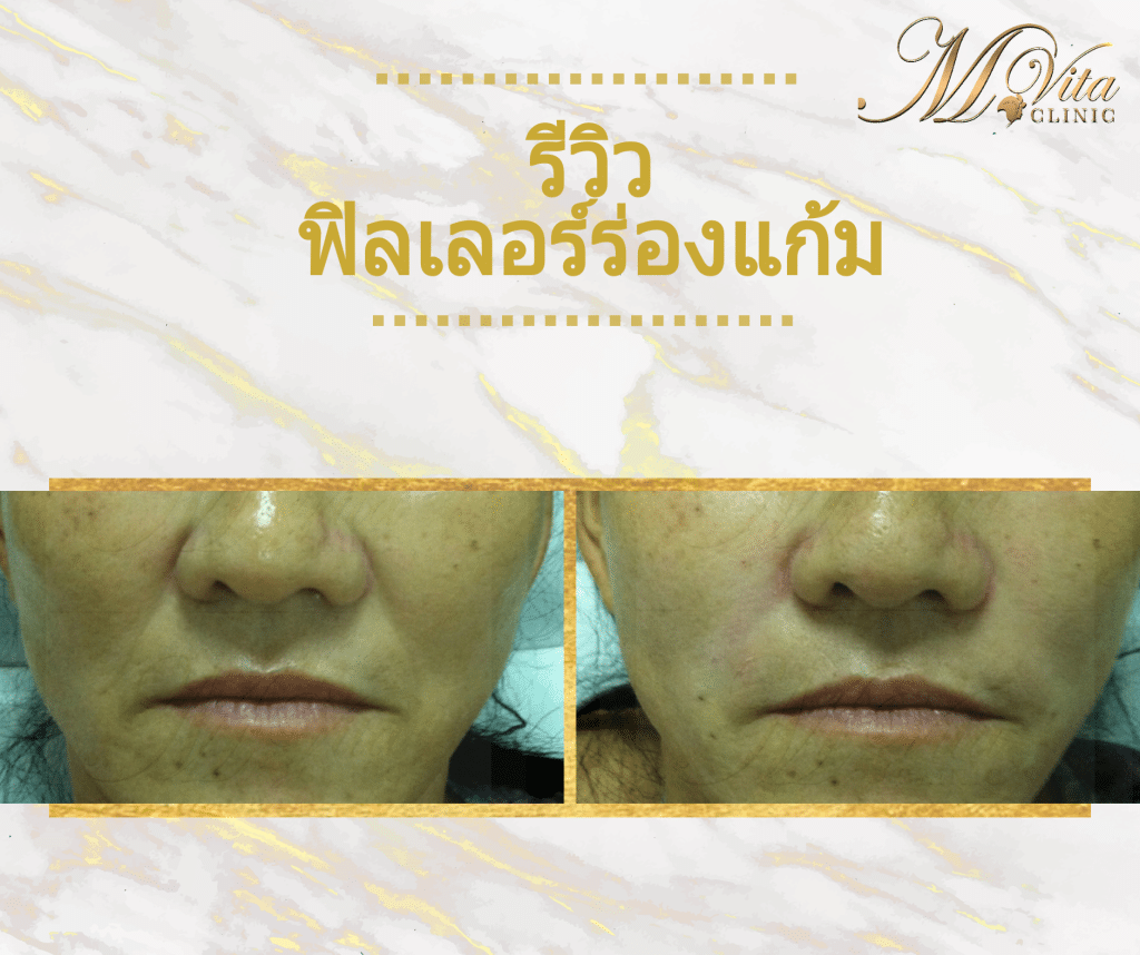 รีวิวผลลัพธ์การฉีดฟิลเลอร์ร่องแก้ม