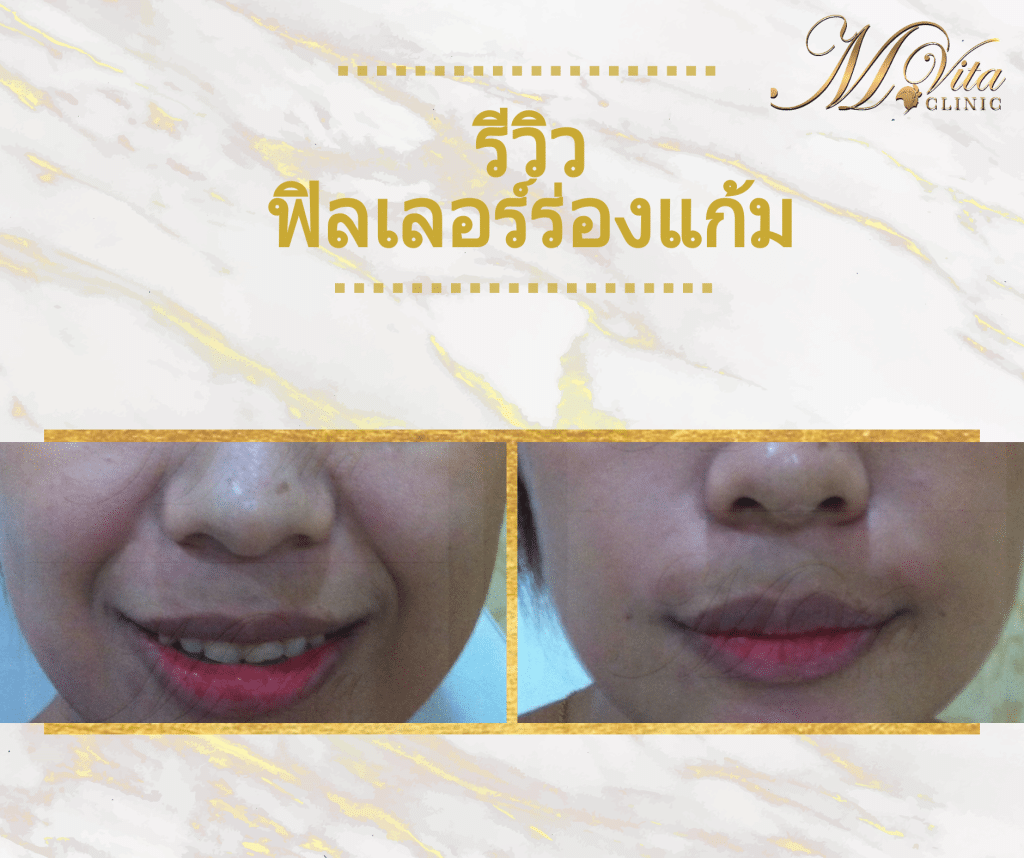 รีวิวบริการฟิลเลอร์ร่องแก้มที่เอ็มวีต้าคลินิก