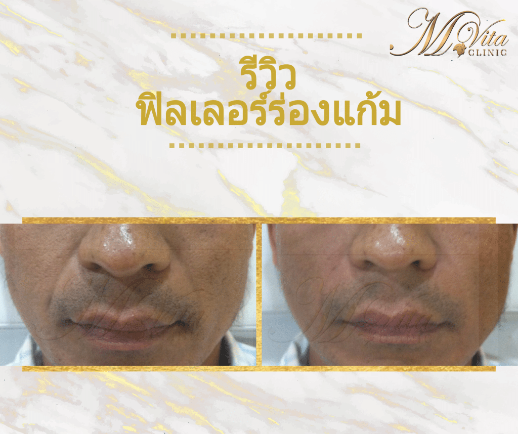 รีวิวฉีดฟิลเลอร์ร่องแก้มที่เอ็มวีต้า