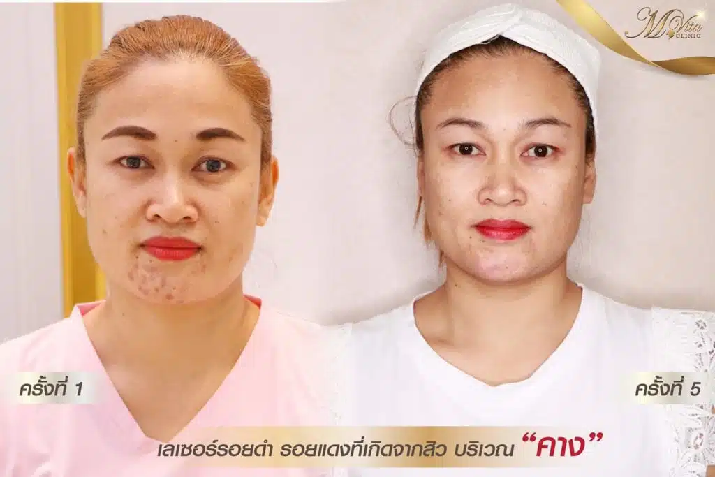 สิวที่คาง