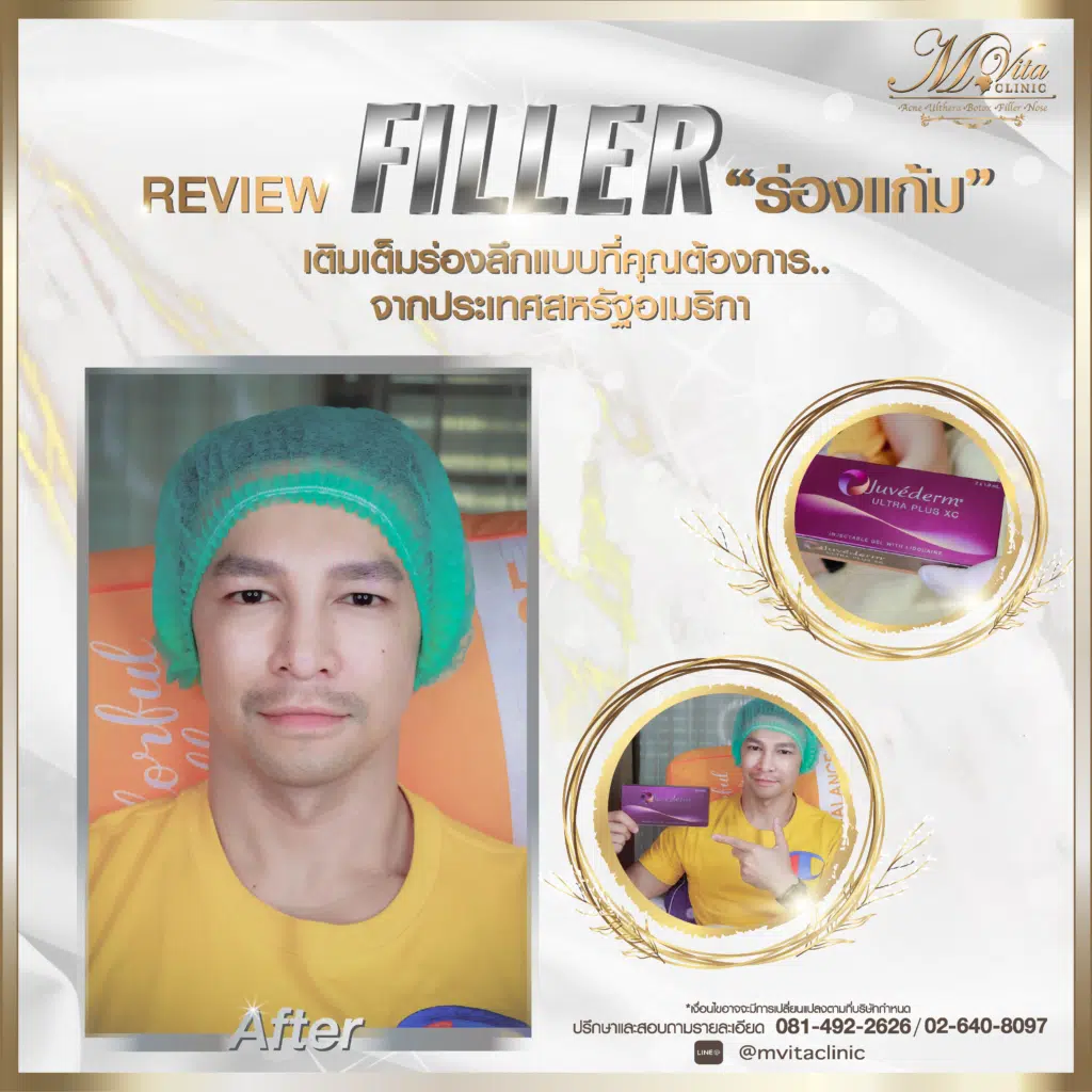 รีวิวหลังฉีดฟิลเลอร์ร่องแก้ม