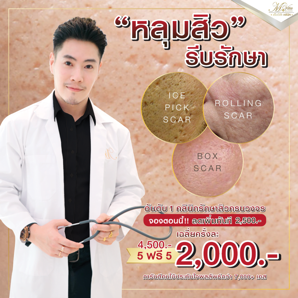 รักษาหลุมสิว