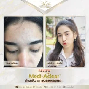 รีวิว รักษาสิว และ รอย