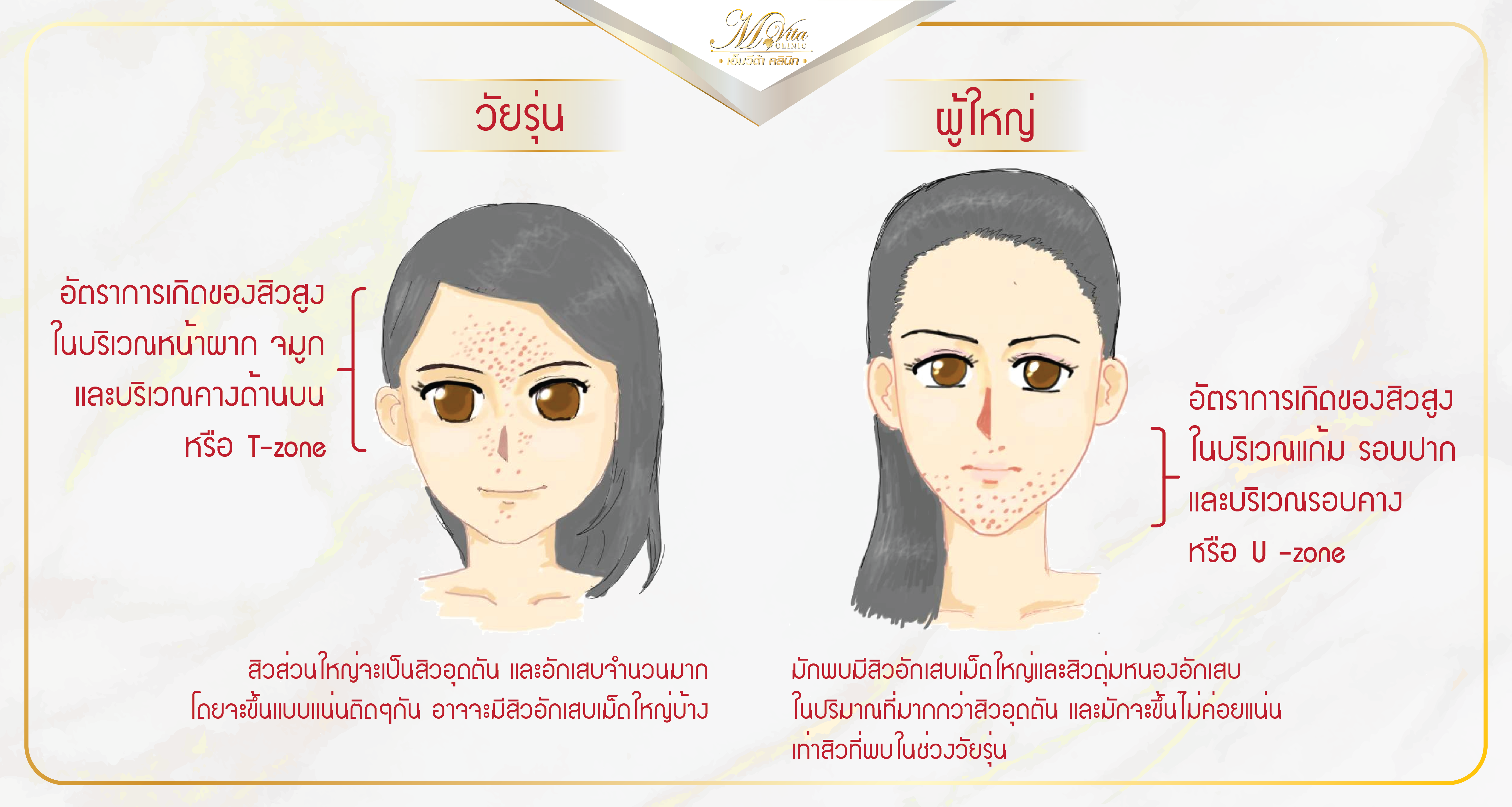 สิวขึ้นคาง