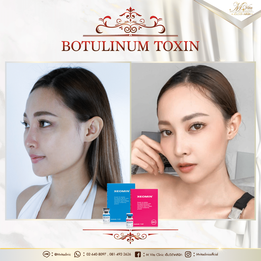 Xeomin รีวิว คุณอุ้ม