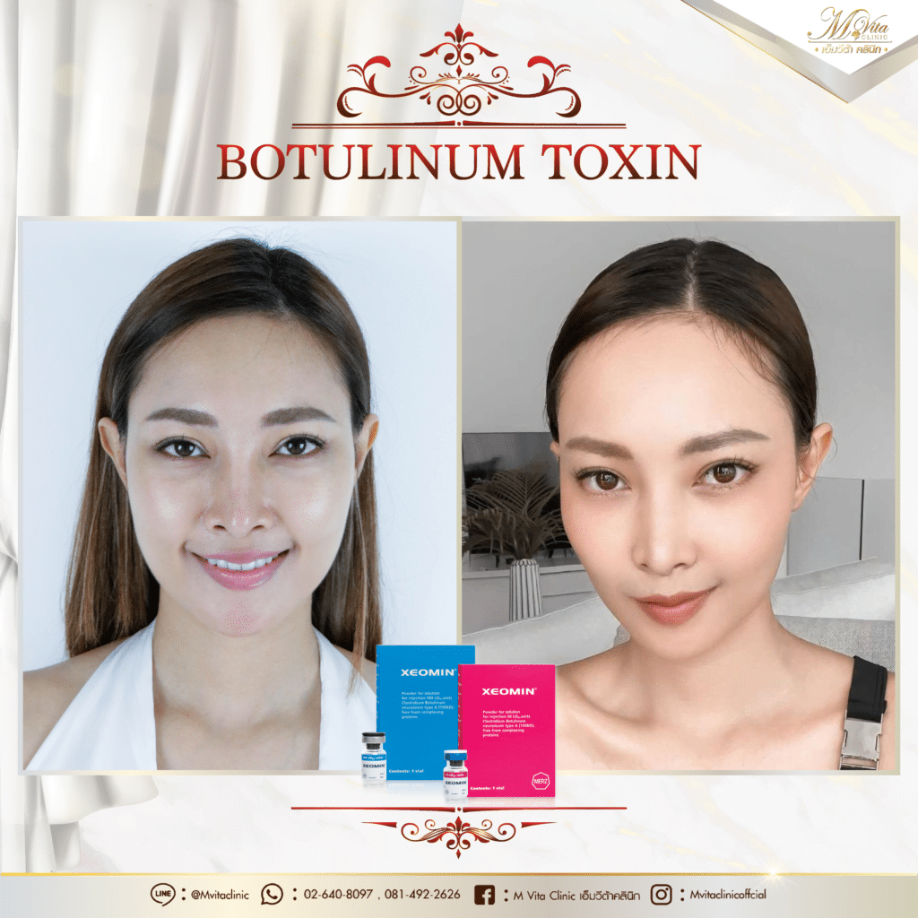 Xeomin รีวิว คุณ อุ้ม