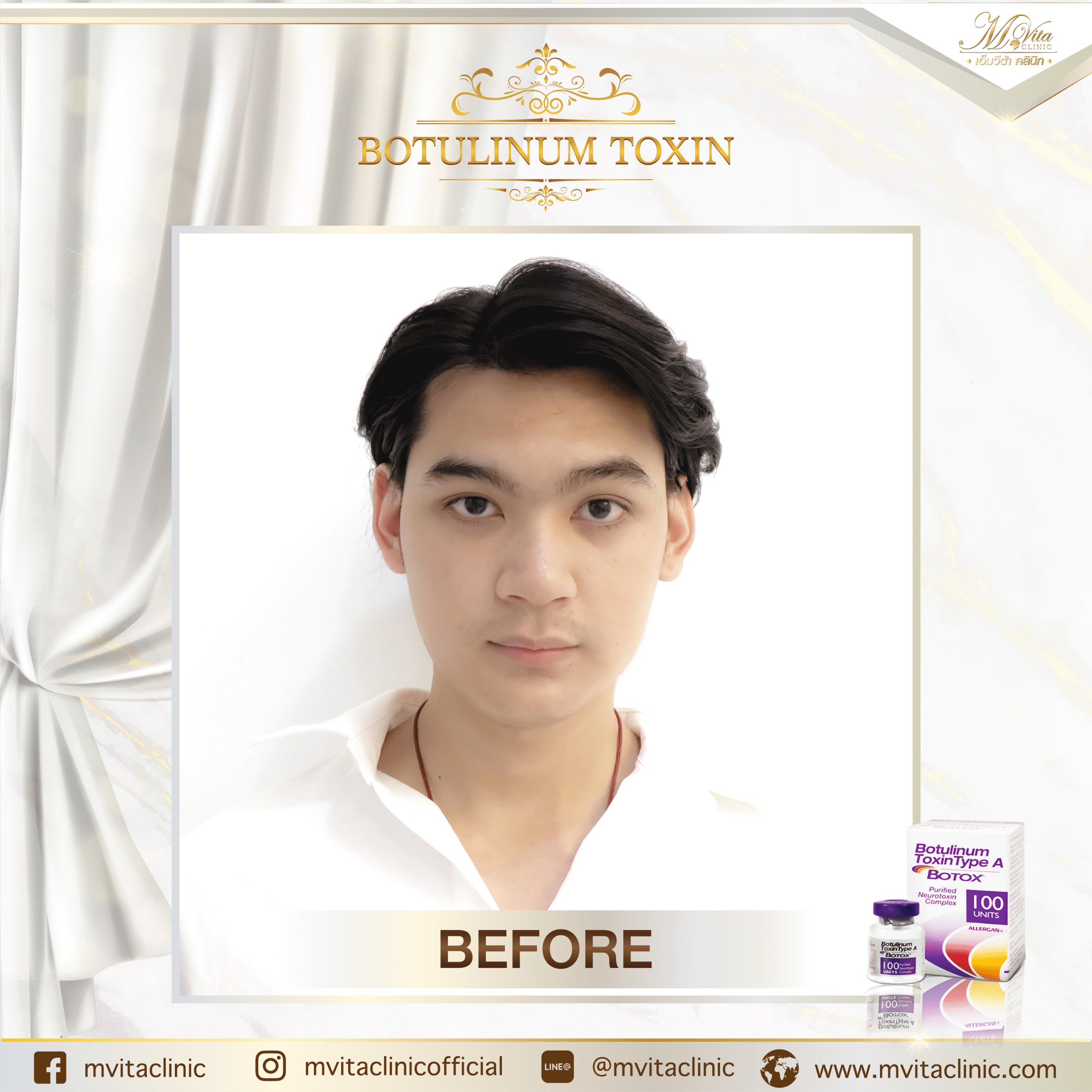 รีวิว Allergan Botox 2