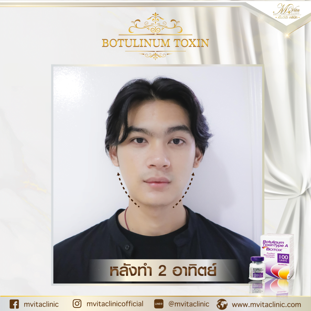 รีวิว Allergan Botox 3
