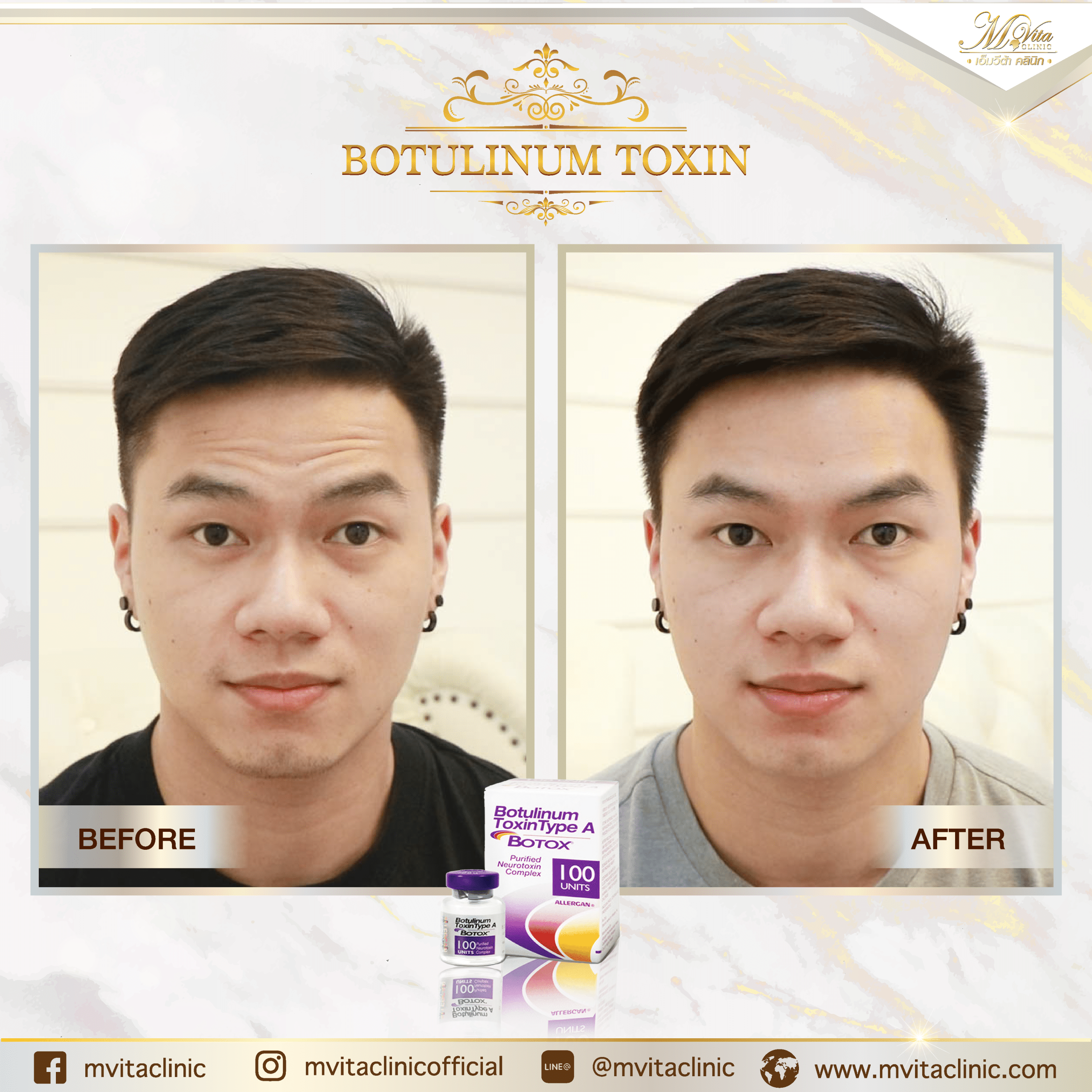 รีวิว Allergan คุณสมาท