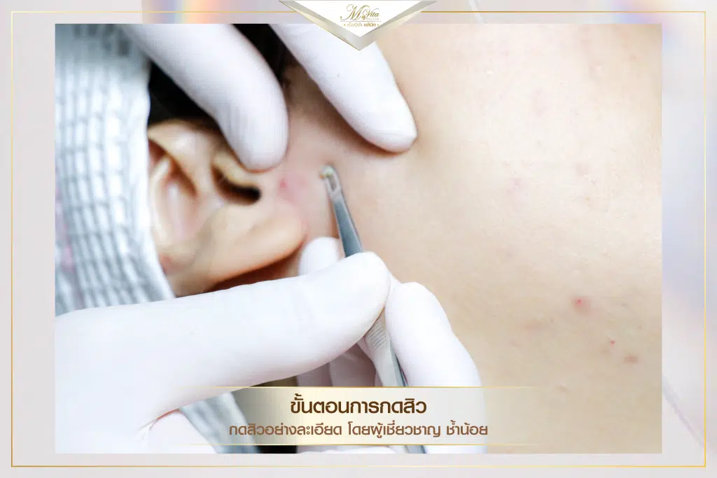 คอร์สรักษาสิว ราคา รีวิว คุณตอง-05