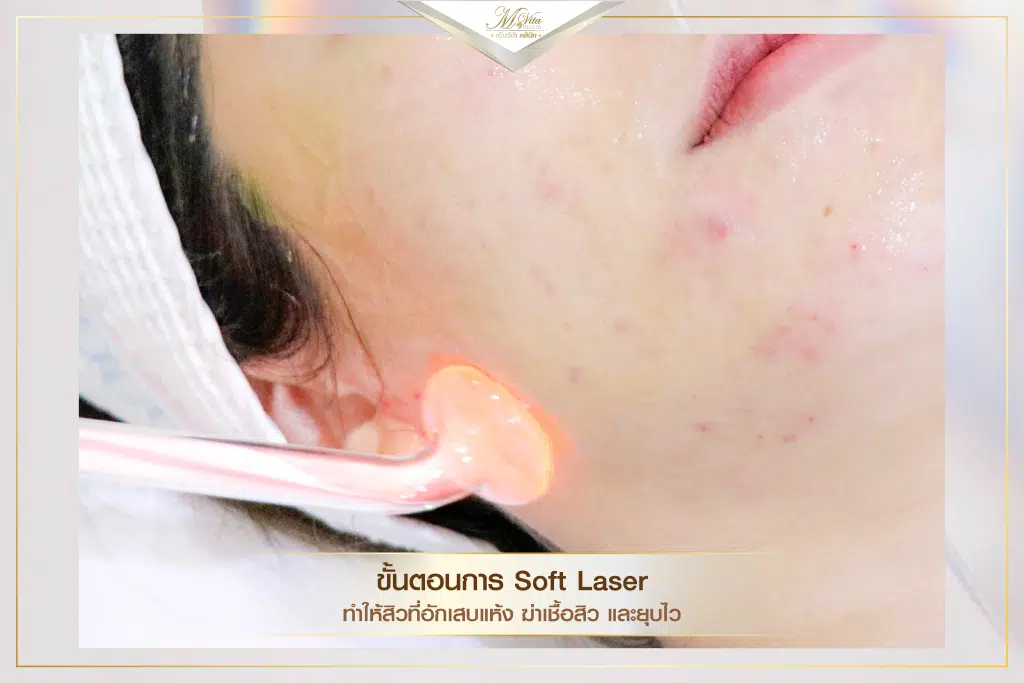 คอร์สรักษาสิว ราคา รีวิว คุณตอง-06