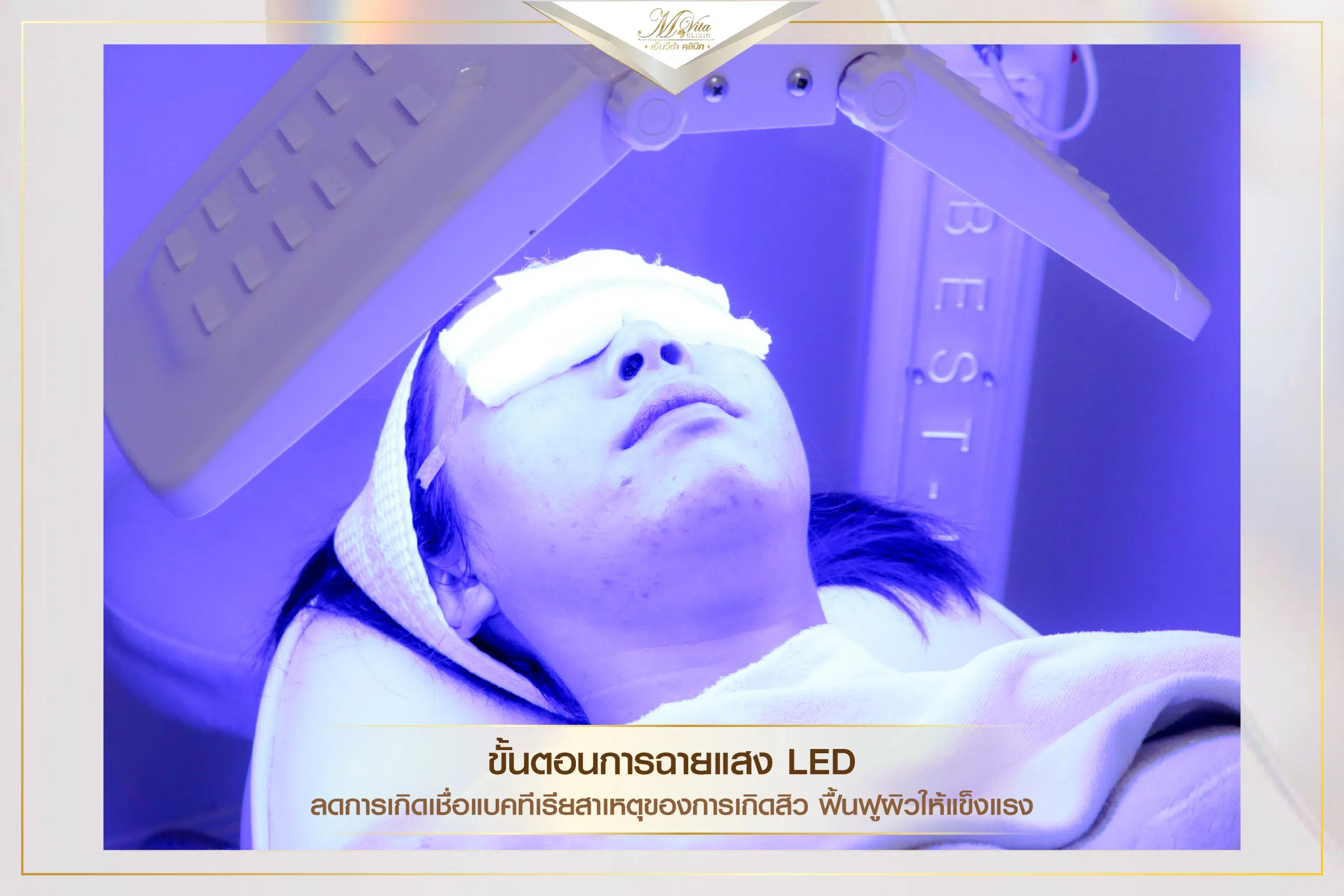 ฉายแสง ฆ่าเชื้อสิว