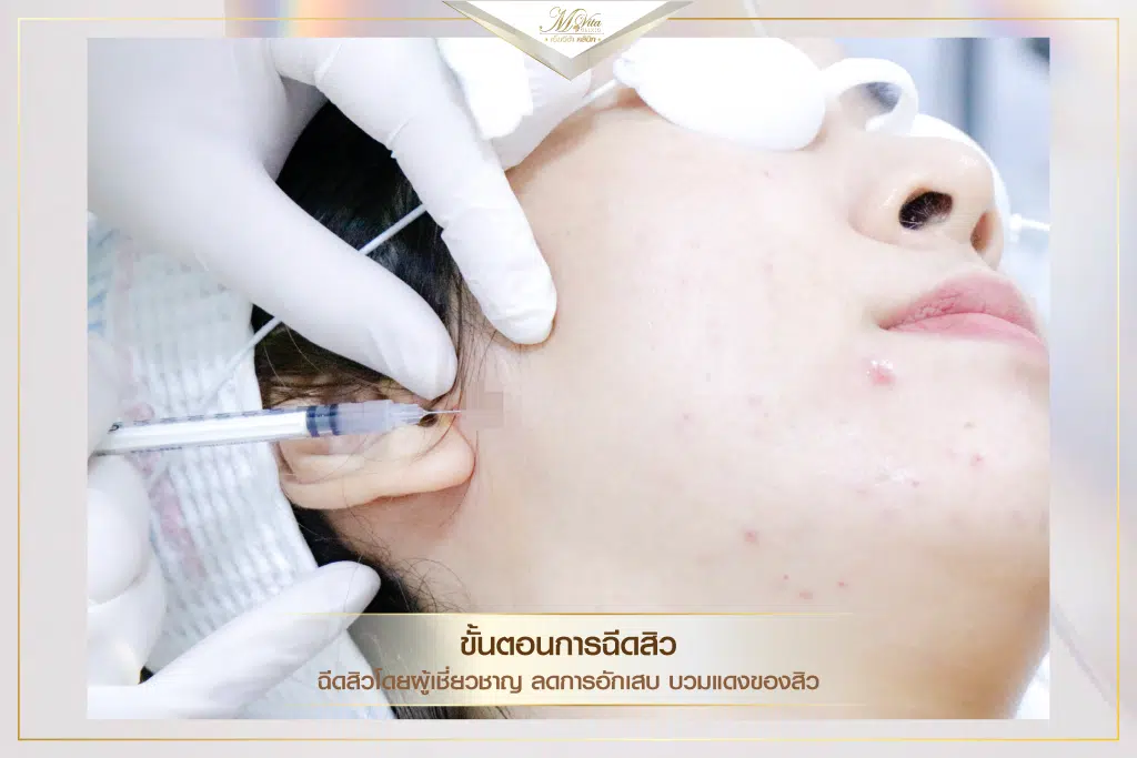 คอร์สรักษาสิว ราคา รีวิว คุณตอง-08