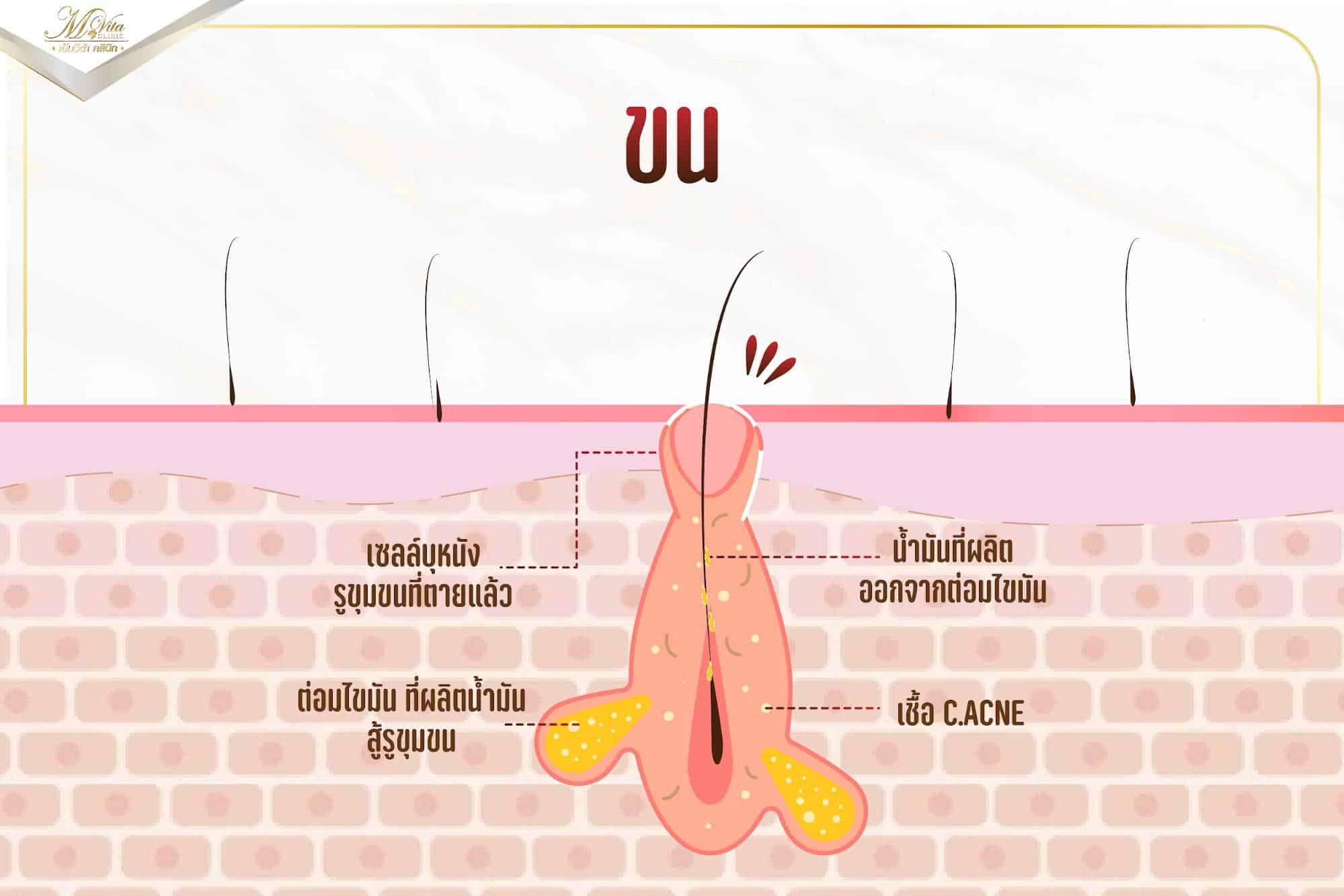 วิธีรักษาสิวอุดตัน