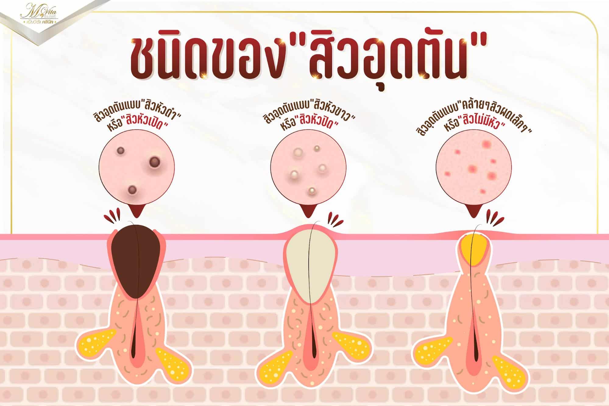 เลเซอร์สิวอุดตัน ราคา