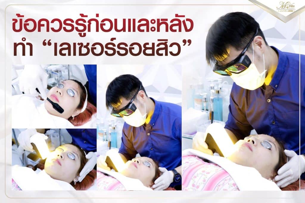 เลเซอร์ลดรอยสิว