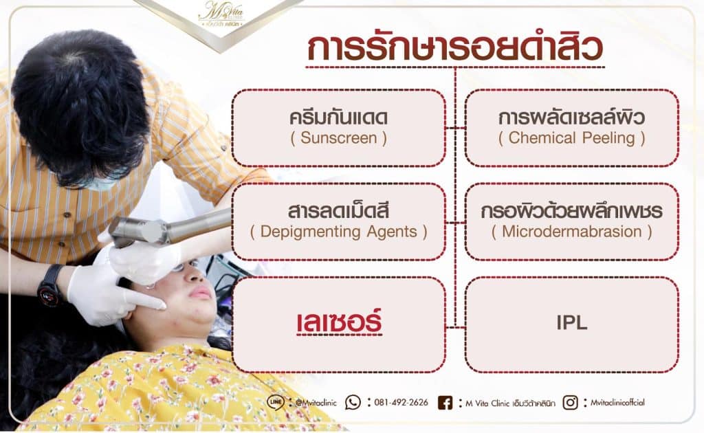 การรักษารอยดำสิว