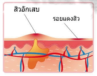 สาเหตุของรอยแดงสิว