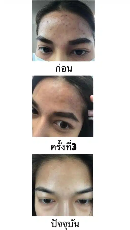 รีวิว จาก คุณเปิ้ล รักษาสิว