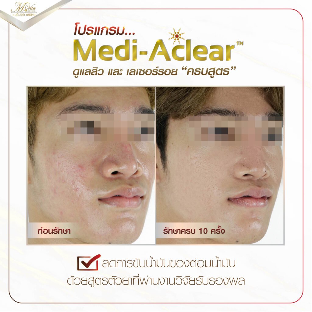 รีวิว รักษาสิว ที่ เอ็มวีต้า คลินิก