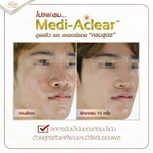 รีวิว รักษาสิว ที่ เอ็มวีต้า คลินิก