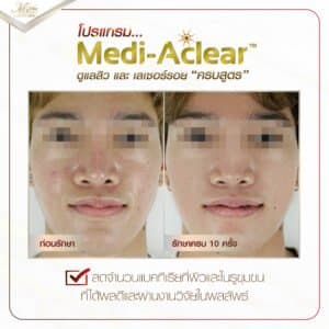 รีวิว รักษาสิว ที่ เอ็มวีต้า คลินิก