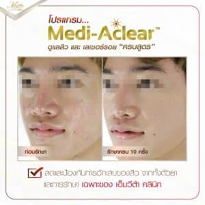 รีวิว รักษาสิว ที่ เอ็มวีต้า คลินิก