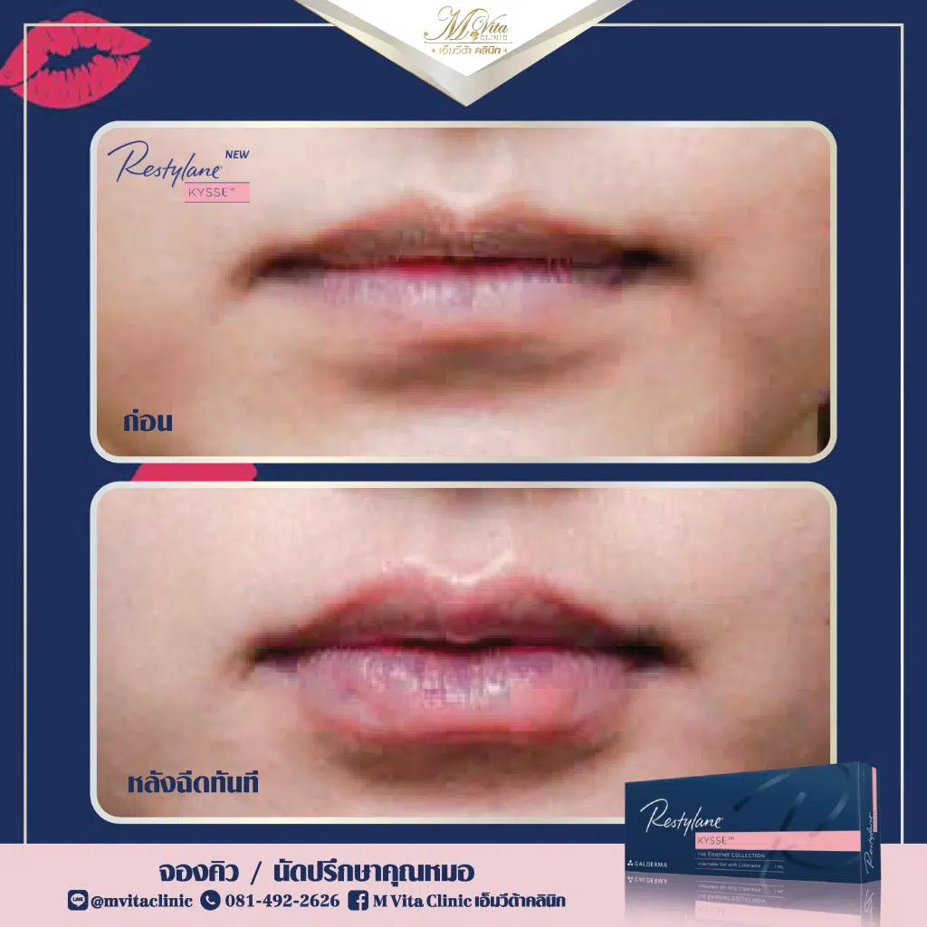 ฟิลเลอร์ปาก