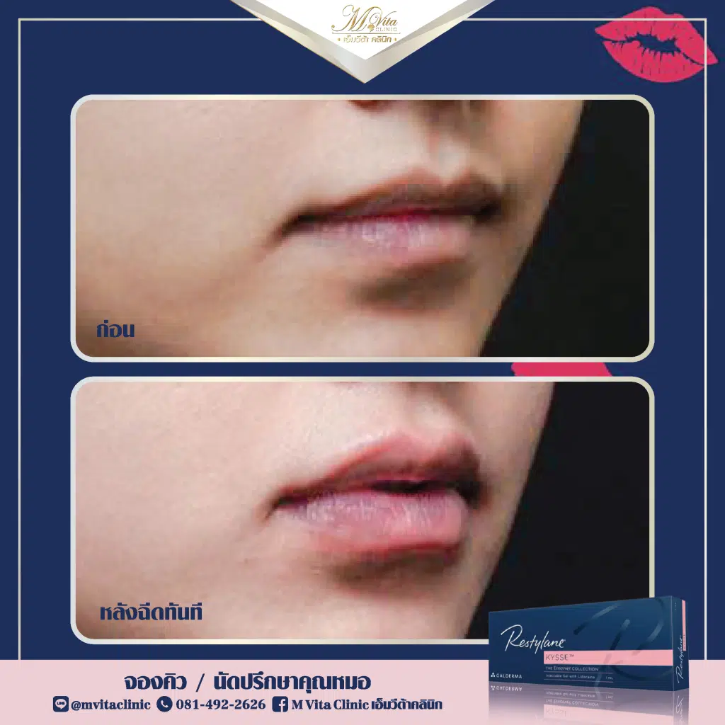 ฟิลเลอร์ปาก