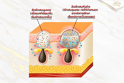 สิวหลัง