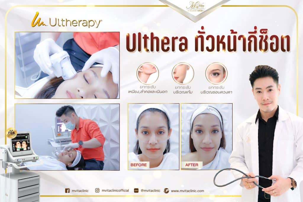 Ulthera ทั่วหน้ากี่ช็อต​