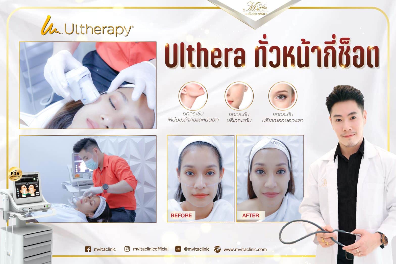 Ulthera ทั่วหน้ากี่ช็อต​