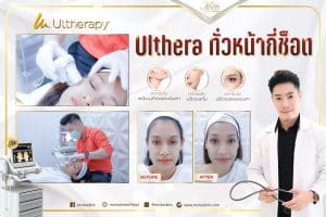 Ulthera ทั่วหน้ากี่ช็อต​