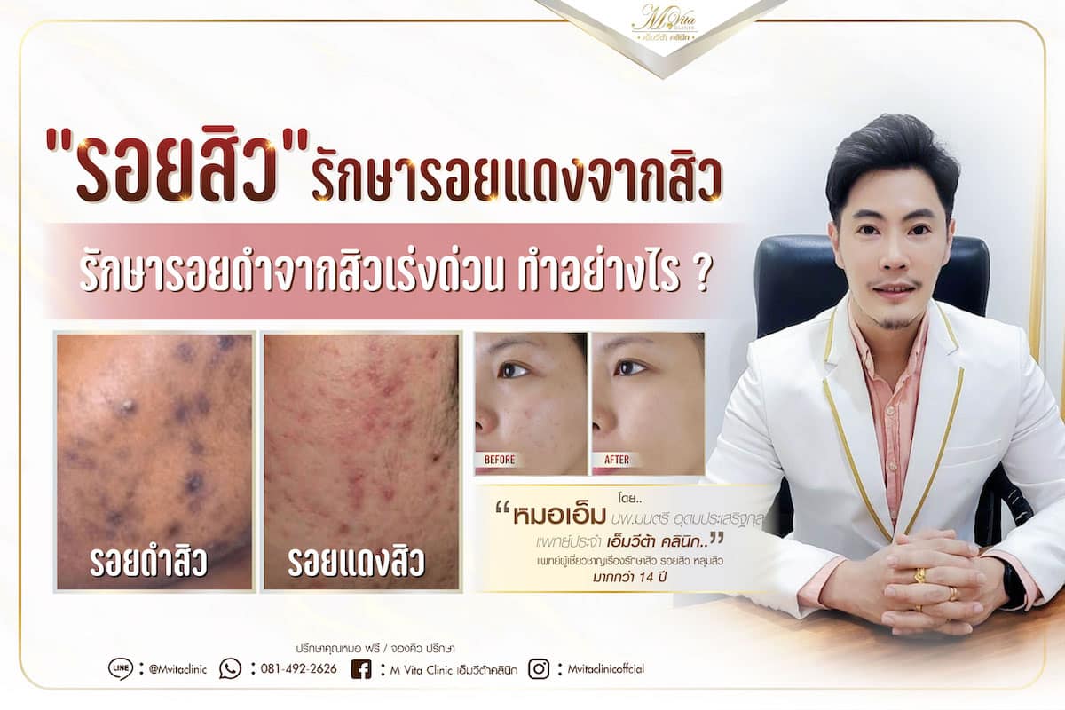 รอยสิว รักษารอยแดงจากสิว รักษารอยดําจากสิวเร่งด่วน ทำอย่างไร ? รอยสิว รักษารอยแดงจากสิว รักษารอยดําจากสิวเร่งด่วน ทำอย่างไร ?