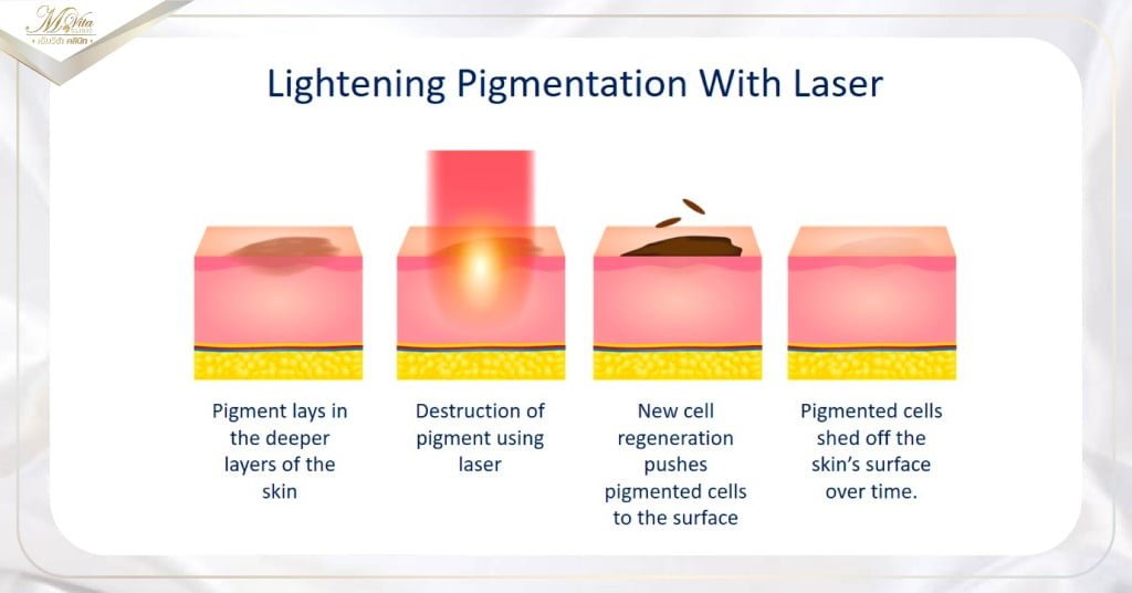 Pigment Laser