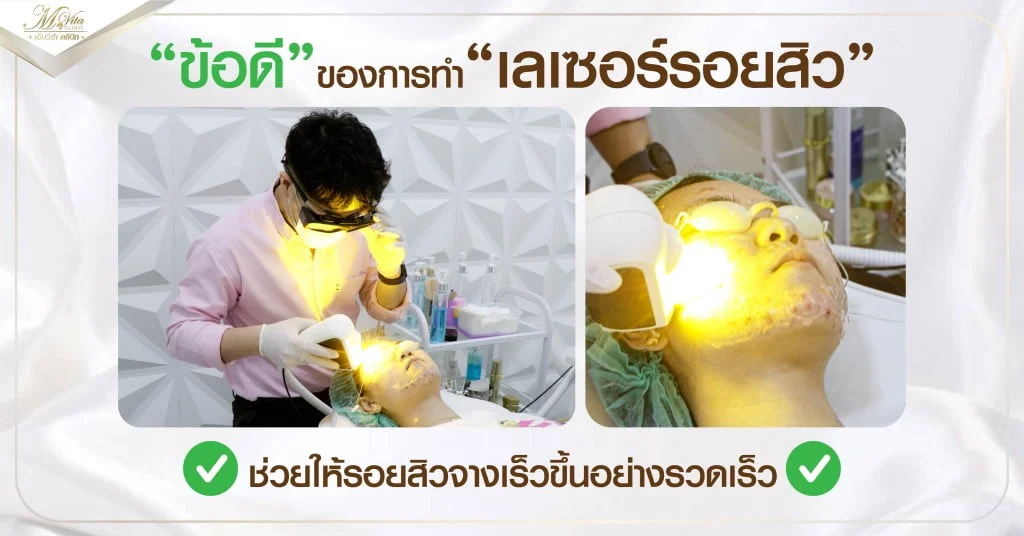 ข้อดีของการเลเซอร์รอยสิว