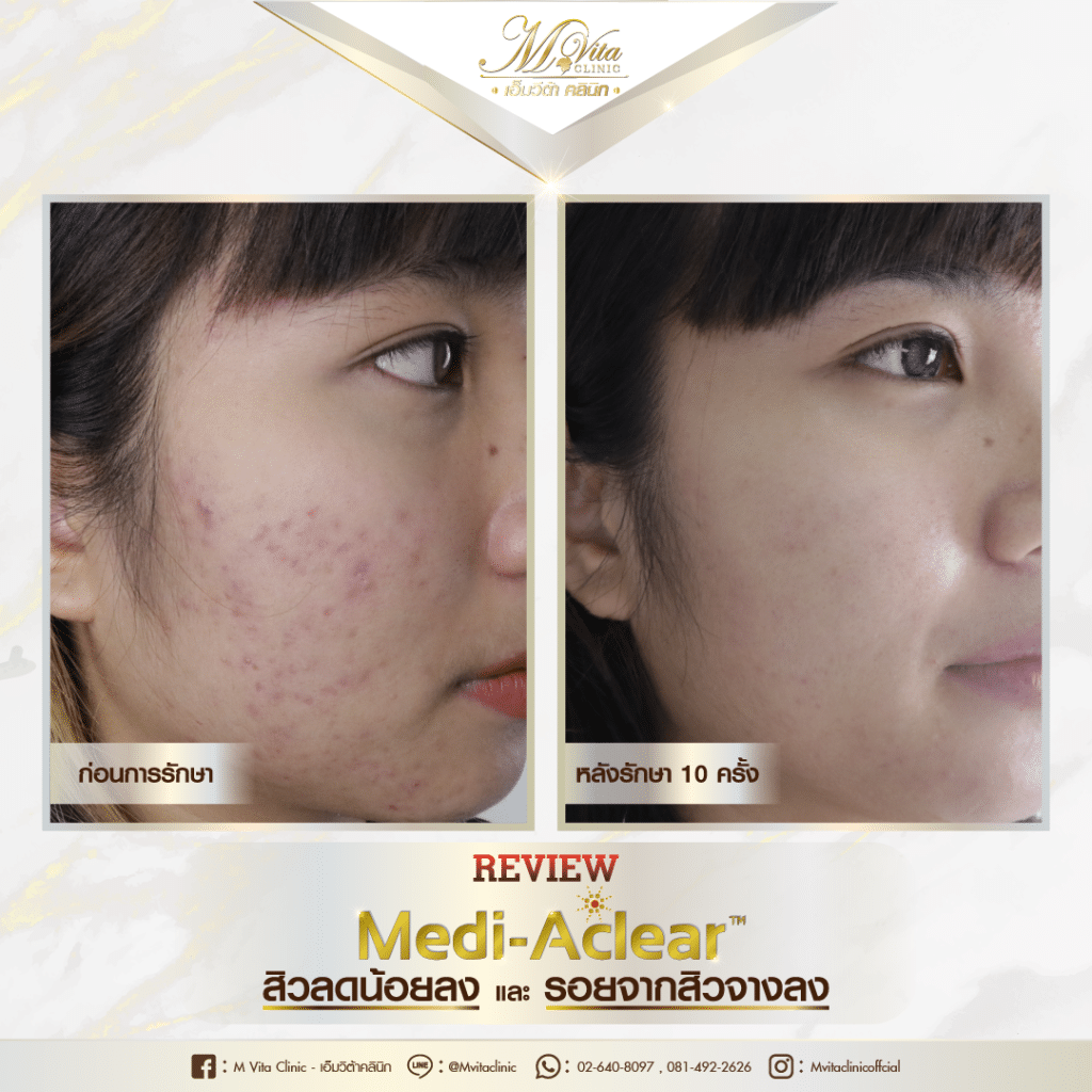 รีวิวรักษาสิวและรอยสิว ด้วย Q-switched laser-1