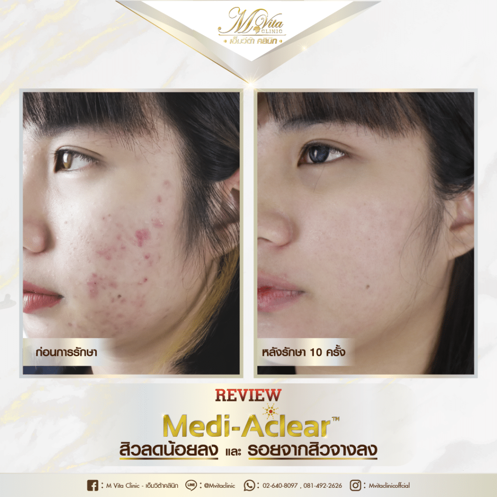รีวิวรักษาสิวและรอยสิว ด้วย Q-switched laser-2