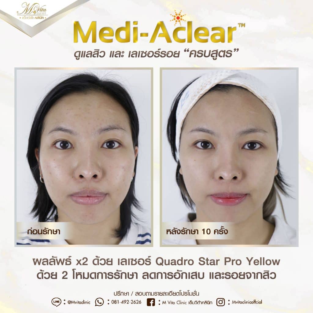 รีวิวรักษาสิวและรอยสิว ด้วย Q-switched laser-3