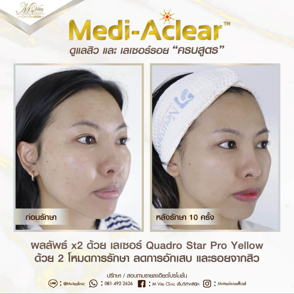 รีวิวรักษาสิวและรอยสิว ด้วย Q-switched laser-4