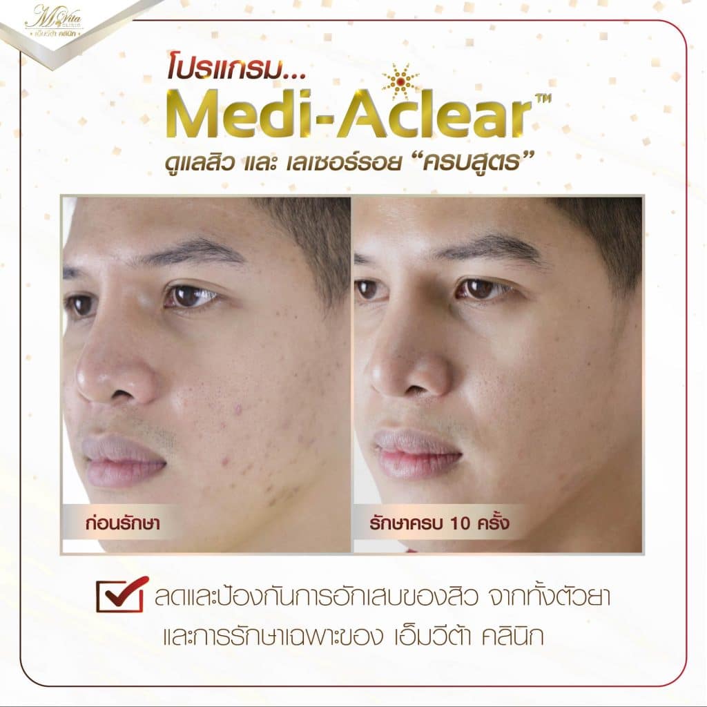 รีวิวรักษาสิวและรอยสิว ด้วย Q-switched laser-7