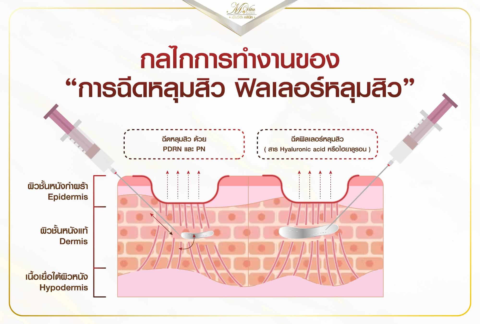 กลไลการทำงานฟิลเลอร์หลุมสิว